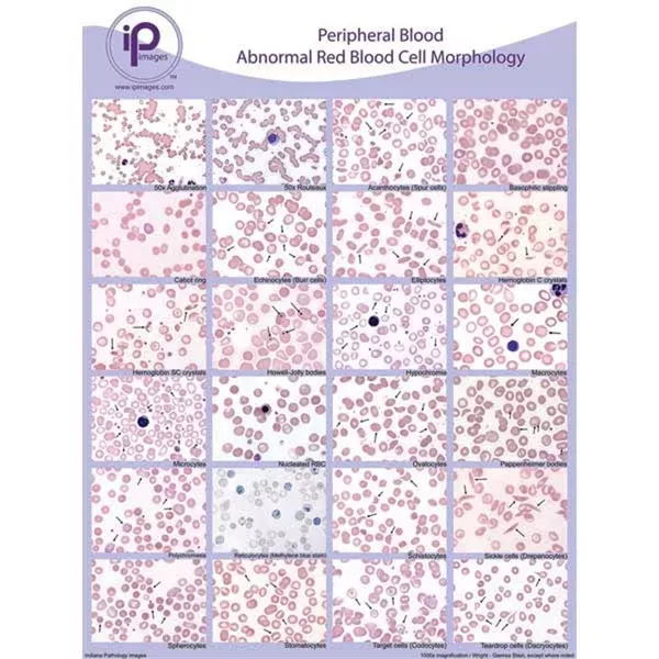 Peripheral Blood Cards and Posters Abnormal RBC Morphology Binder Cards ,10 / pk