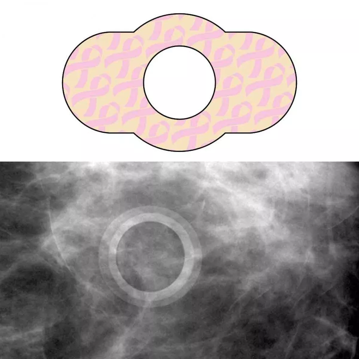 Spee-D-Ring Mammography Skin Marker Mole Radiolucent No Burnout Repositionable 1/2" Inner Diameter - 100 Per Box